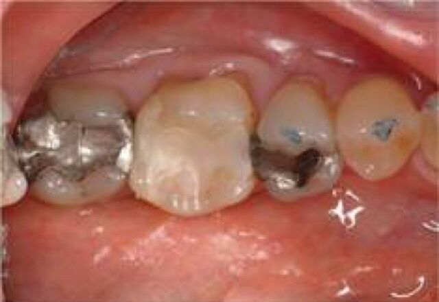 White fillings - before